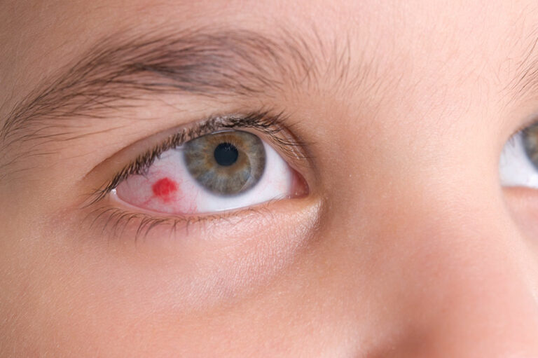 Eye infections – All you need to know